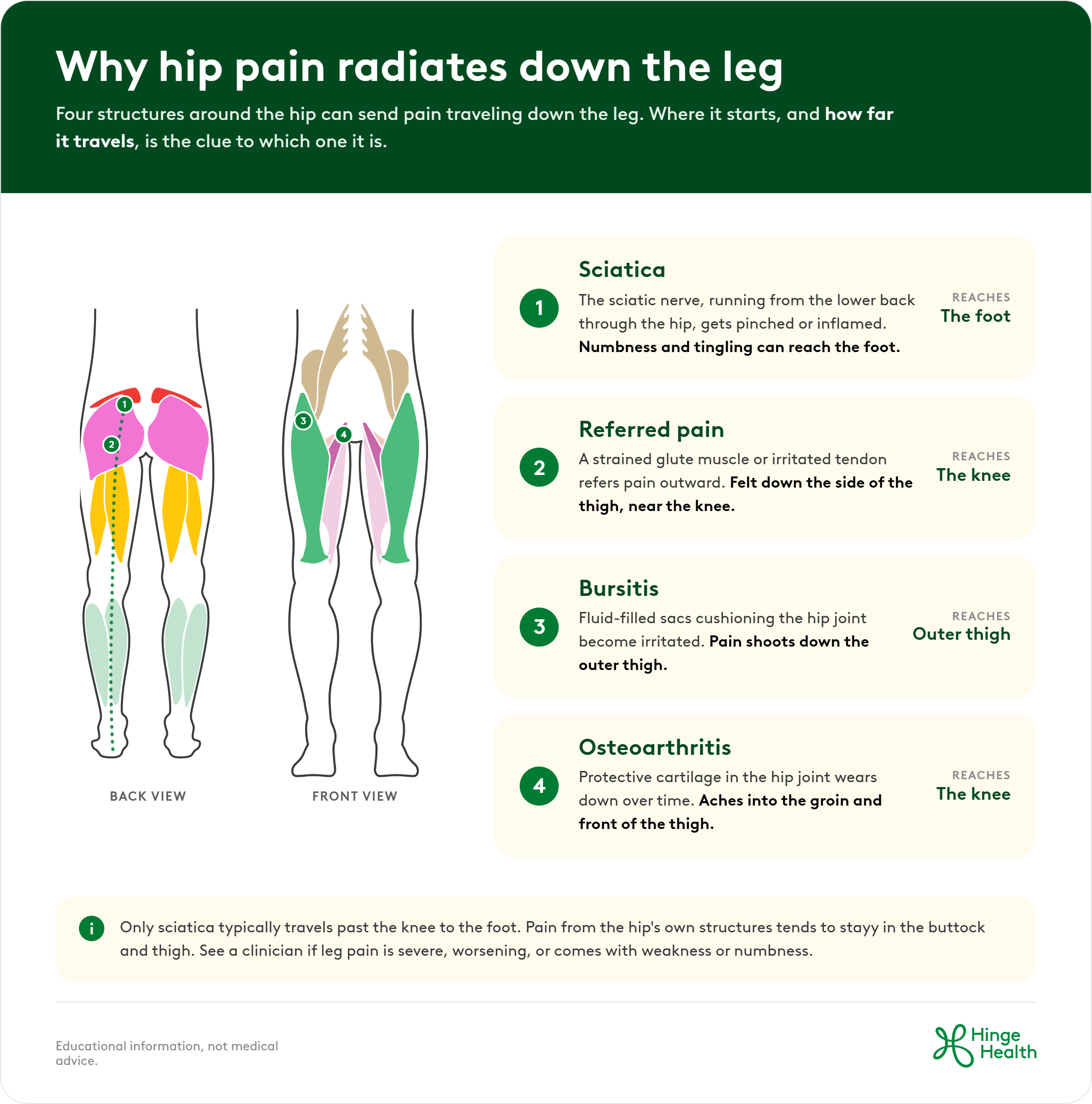 Diagram comparing four causes of hip pain that radiates down the leg — sciatica, referred pain, bursitis, and osteoarthritis — and how far each one typically travels, from the outer thigh to the foot.