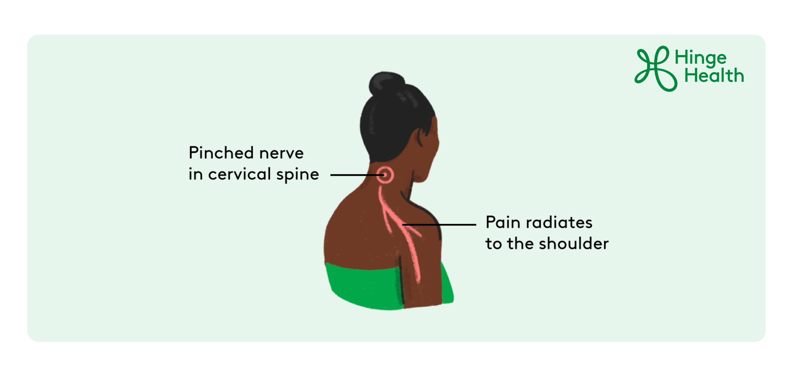 Illustration of a pinched nerve in the cervical spine at the base of the neck, with pain radiating down to the shoulder.