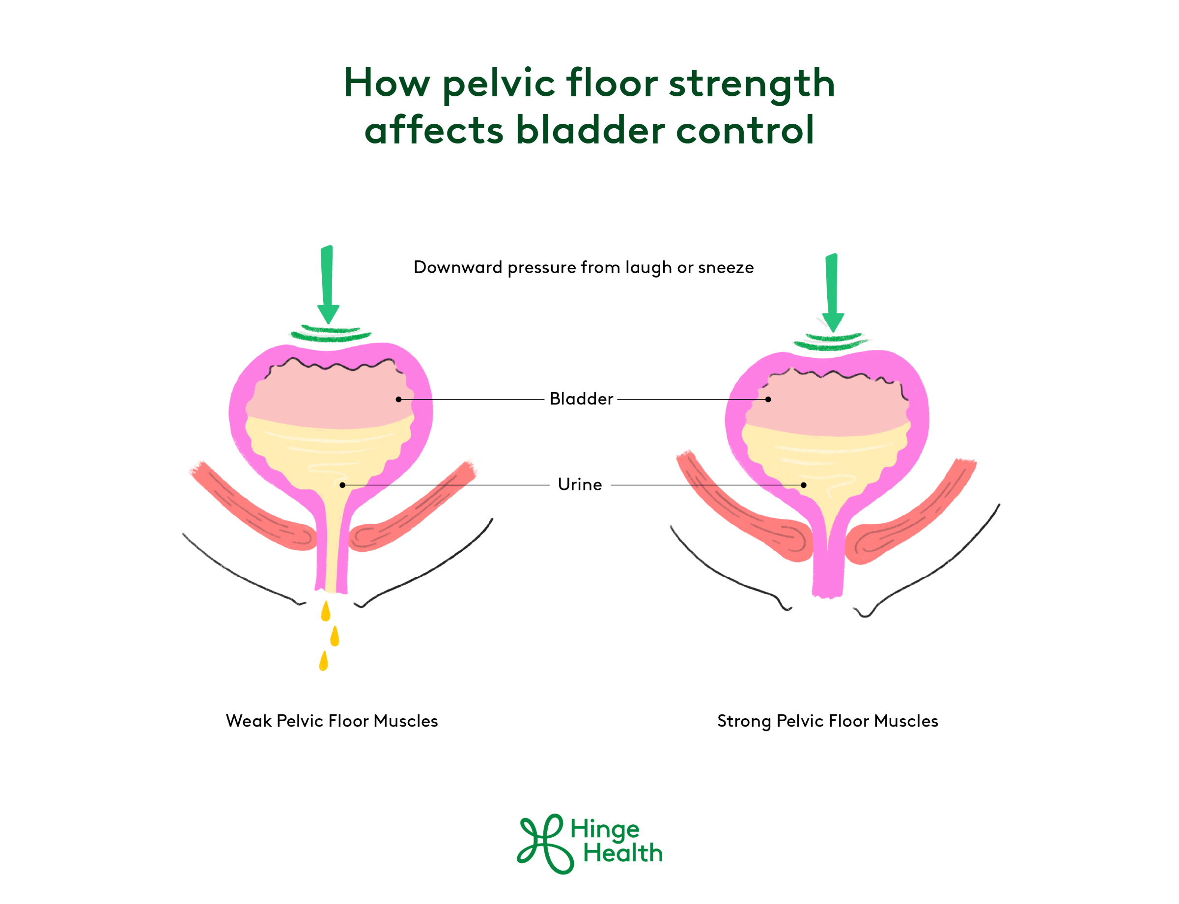 Diagram comparing a bladder with weak pelvic floor muscles, which allows urine to leak under downward pressure from a laugh or sneeze, to one with strong pelvic floor muscles that stays closed under the same pressure.